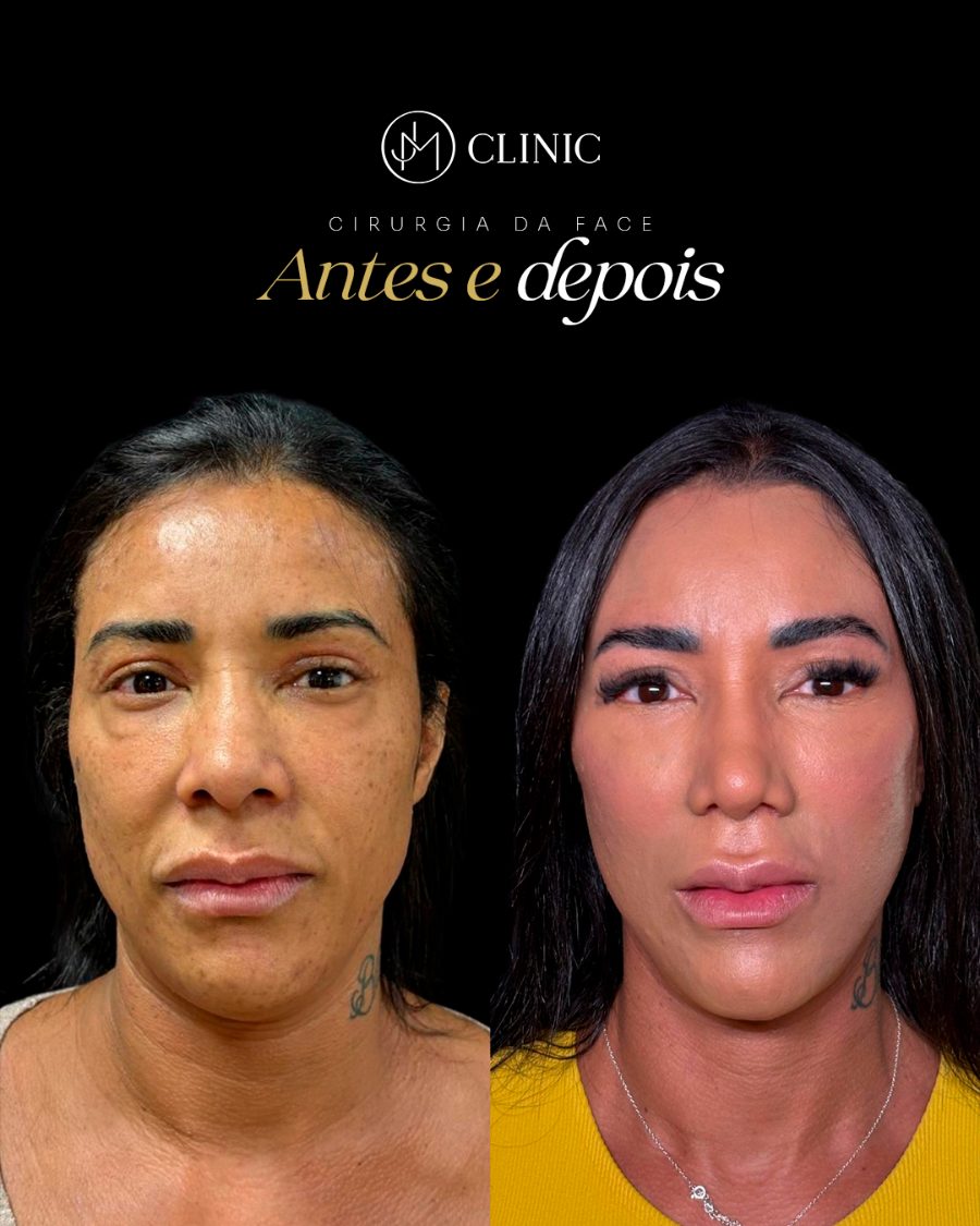 Antes e depois de cirurgia da face na JM Clinic, resultado individual