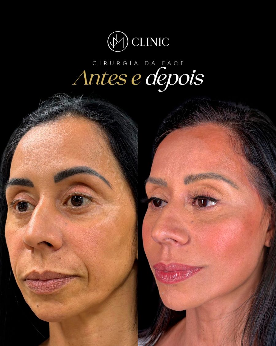 Antes e depois de cirurgia estética da face, JM Clinic Duque de Caxias