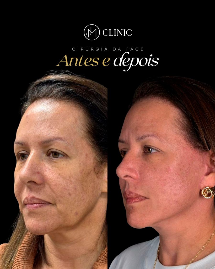 Antes e depois de cirurgia da face, acompanhamento JM Clinic