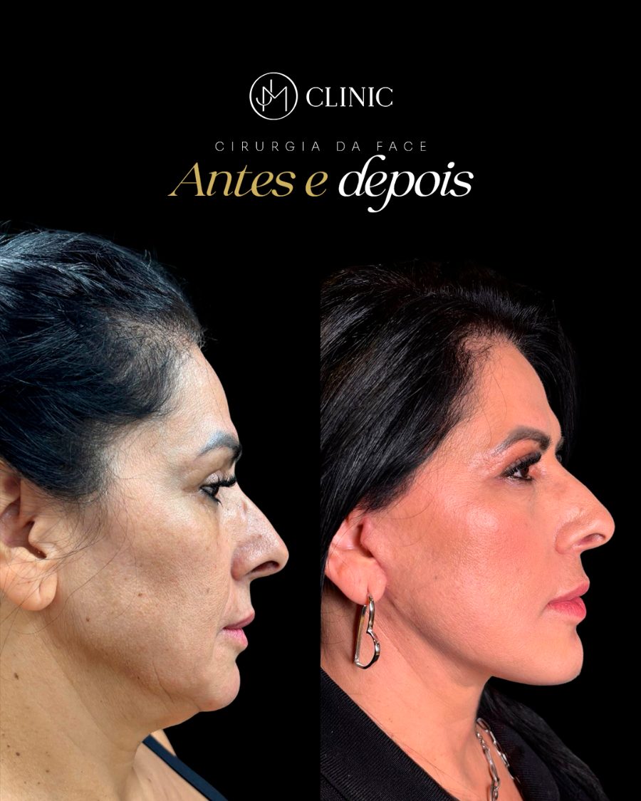 Antes e depois de cirurgia facial, caso com resultado individual