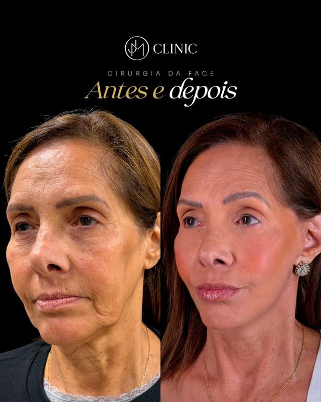 Caso real de cirurgia da face acompanhado pela JM Clinic, imagem 01