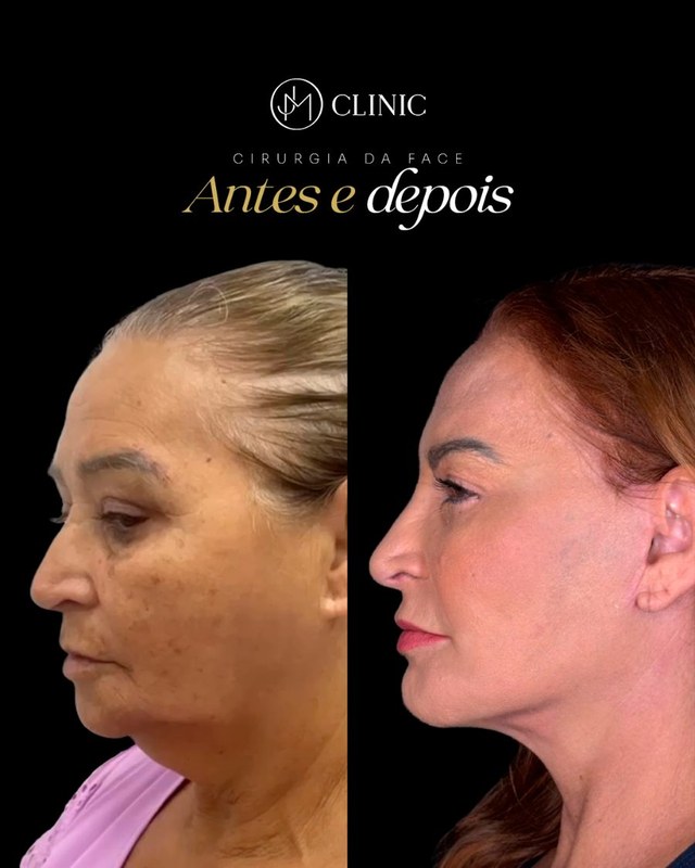 Caso real de cirurgia da face acompanhado pela JM Clinic, imagem 03