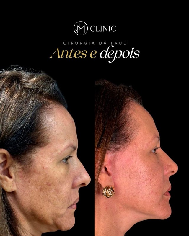 Caso real de cirurgia da face acompanhado pela JM Clinic, imagem 04