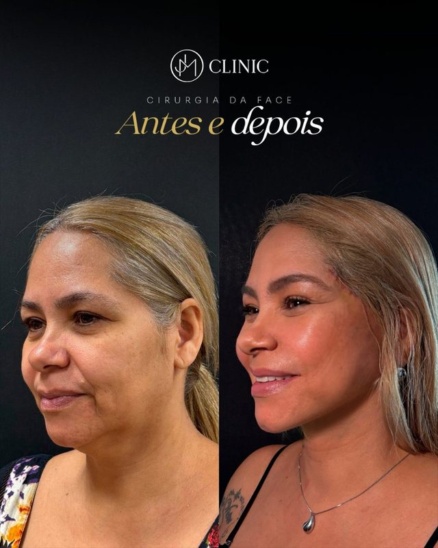 Caso real de cirurgia da face acompanhado pela JM Clinic, imagem 06